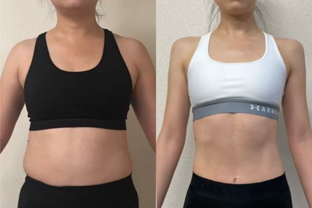 ダイエット整体の施術前後（Before/After）の体型比較写真（女性）