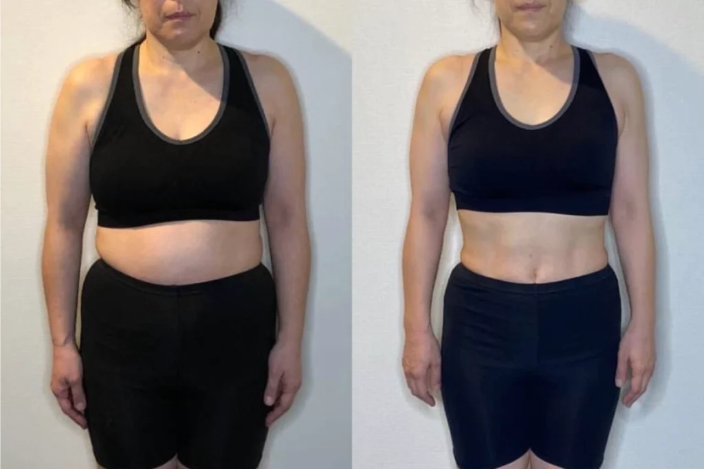 ダイエット整体の施術前後（Before/After）の体型比較写真（女性）